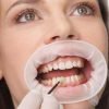 optragate dame die een mondspreider draagt tijdens het tanden bleken
