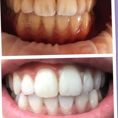 Voor en na foto van tanden bleken