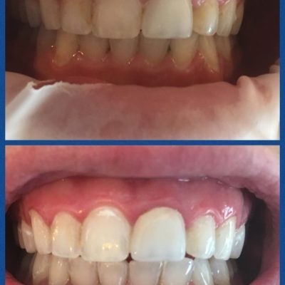 Voor en na foto van tanden bleken